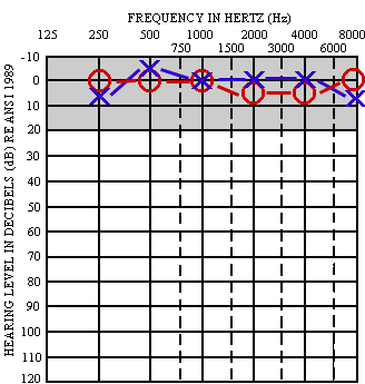 Audiogram for a patient with normal hearing